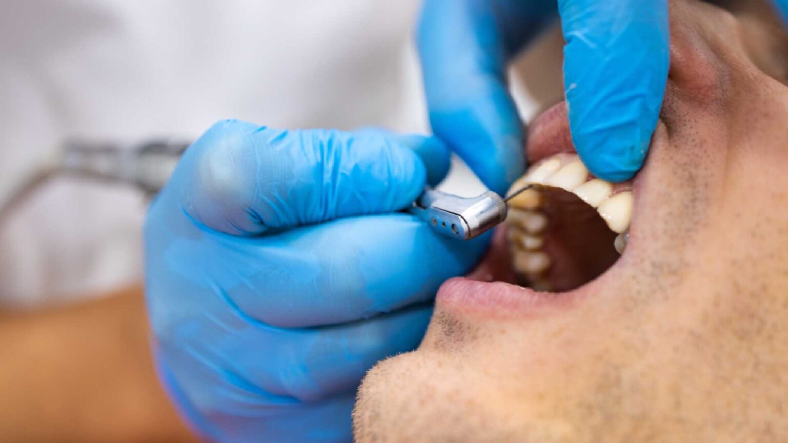 Tooth Patch What You Need to Know to Repair a Chipped Tooth Same Day | Baltimore ...