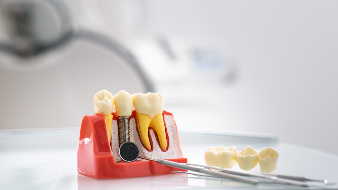 Tooth Extraction
